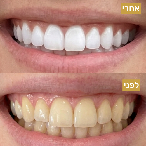 S7 ערכת ההלבנה