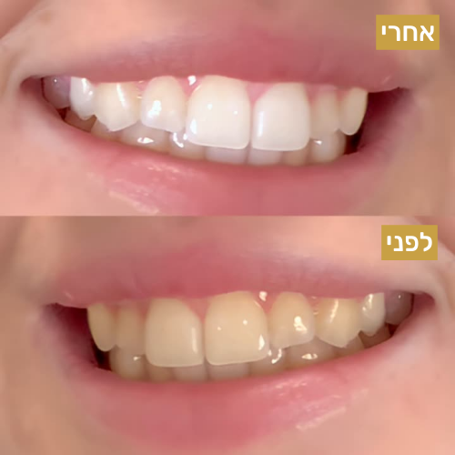 חבילת רצועות הלבנה