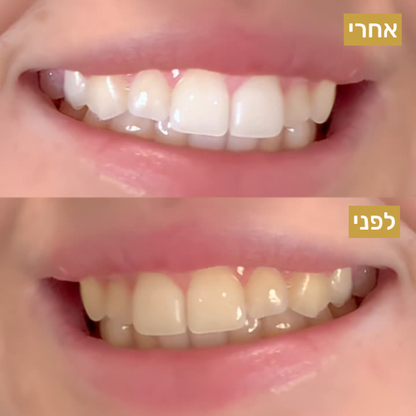 חבילת רצועות הלבנה
